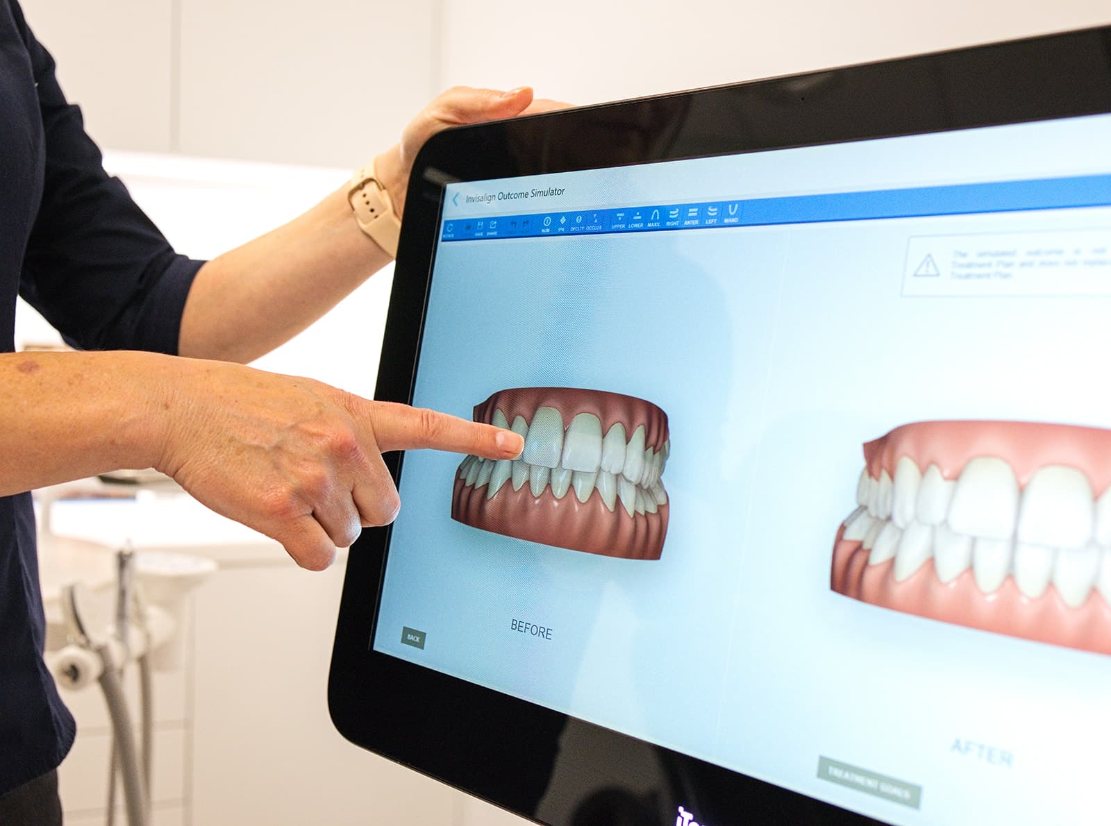Clinician pointing to before and after teeth on the Invisalign Outcome Simulator screen